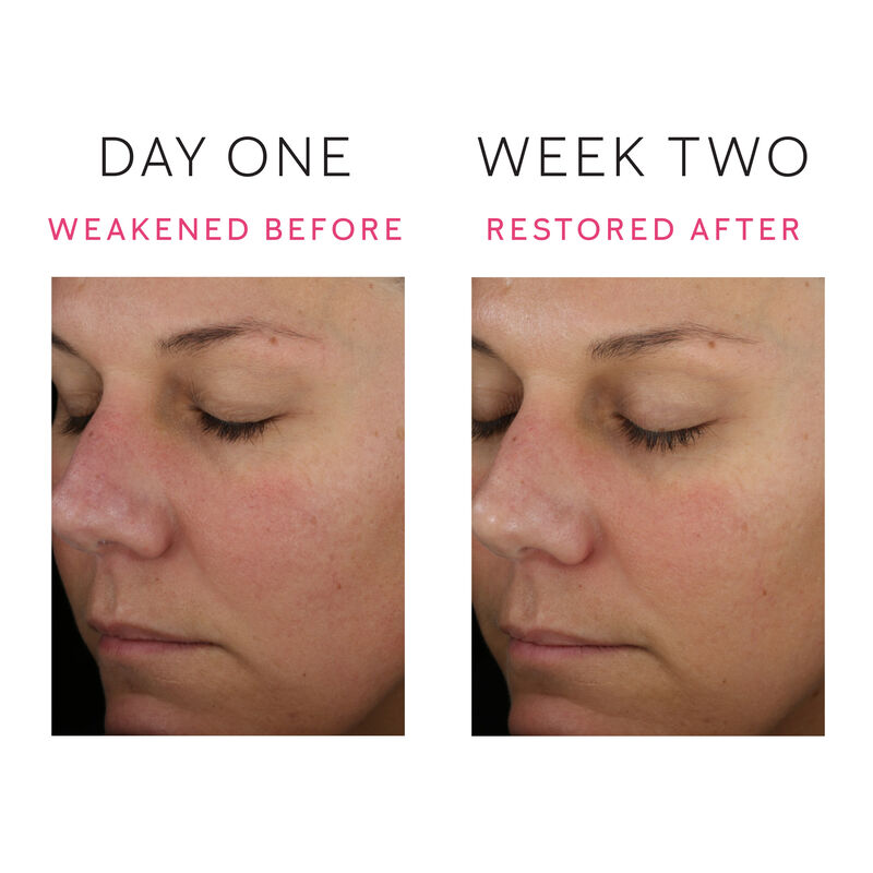 Eine Reihe von Vorher-Nachher-Bildern, die eine Verringerung der Hautr&ouml;tungen vom ersten Tag bis zur zweiten Woche zeigen. image number null