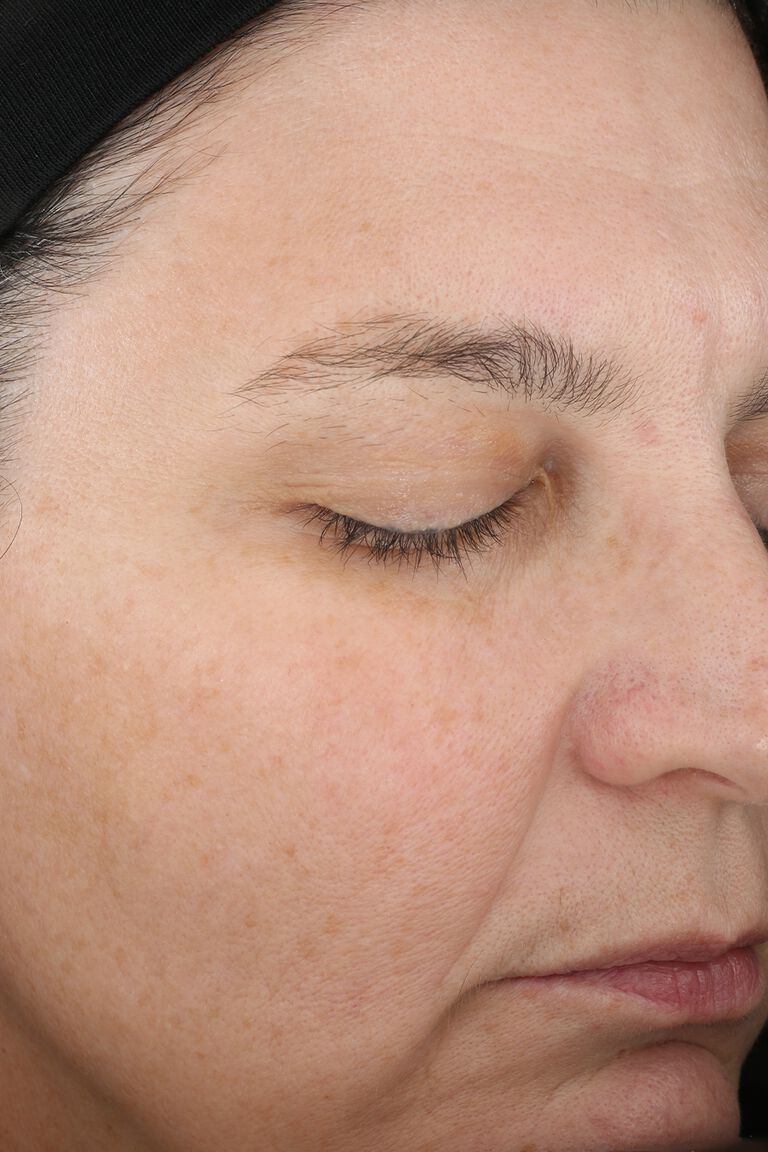 Nahaufnahme der Haut im Gesicht: Eine Frau mit geschlossenen Augen nach der Anwendung des Mary Kay TimeWise "Wunder-Set" (nach 12 Wochen)